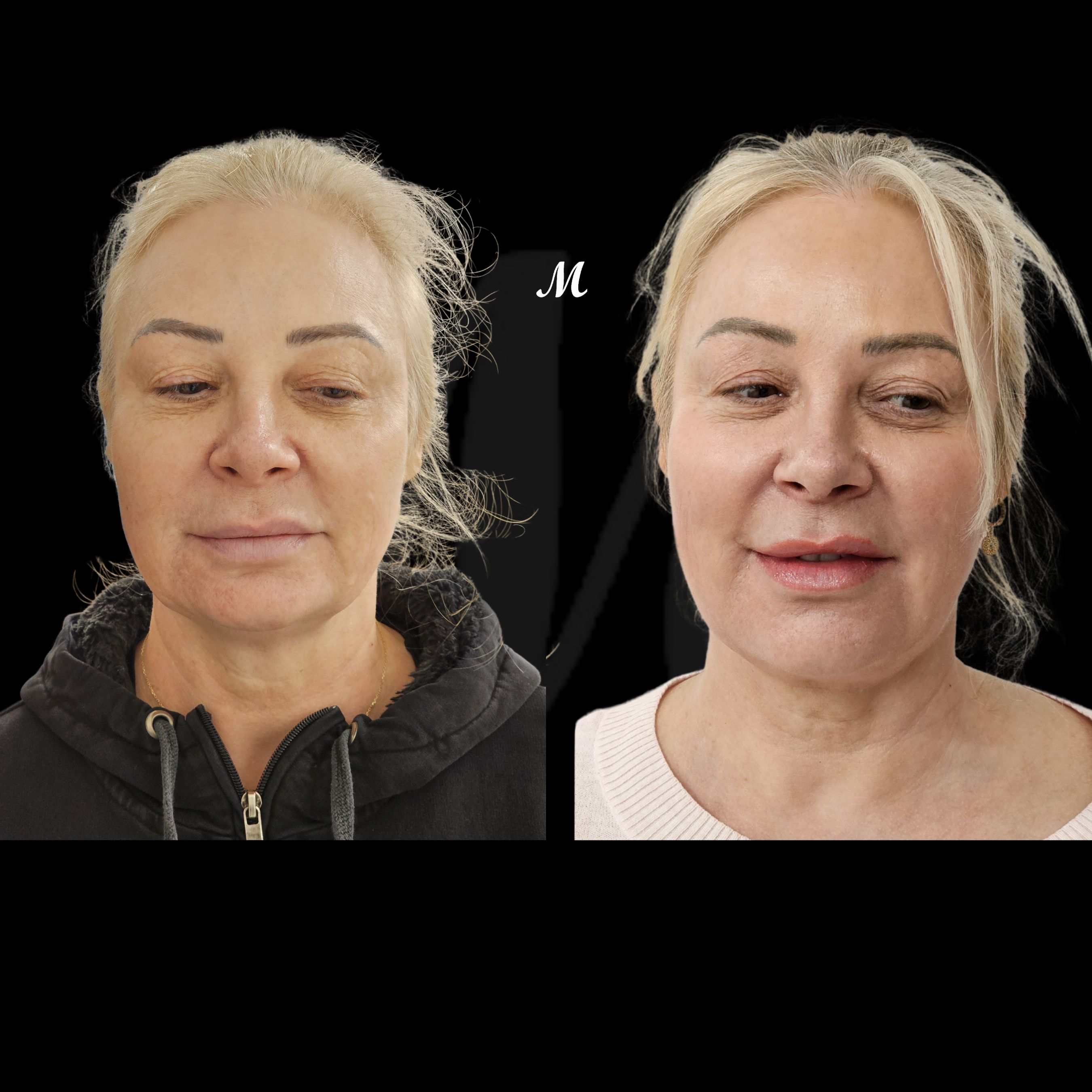 Non-Surgical Facelift
